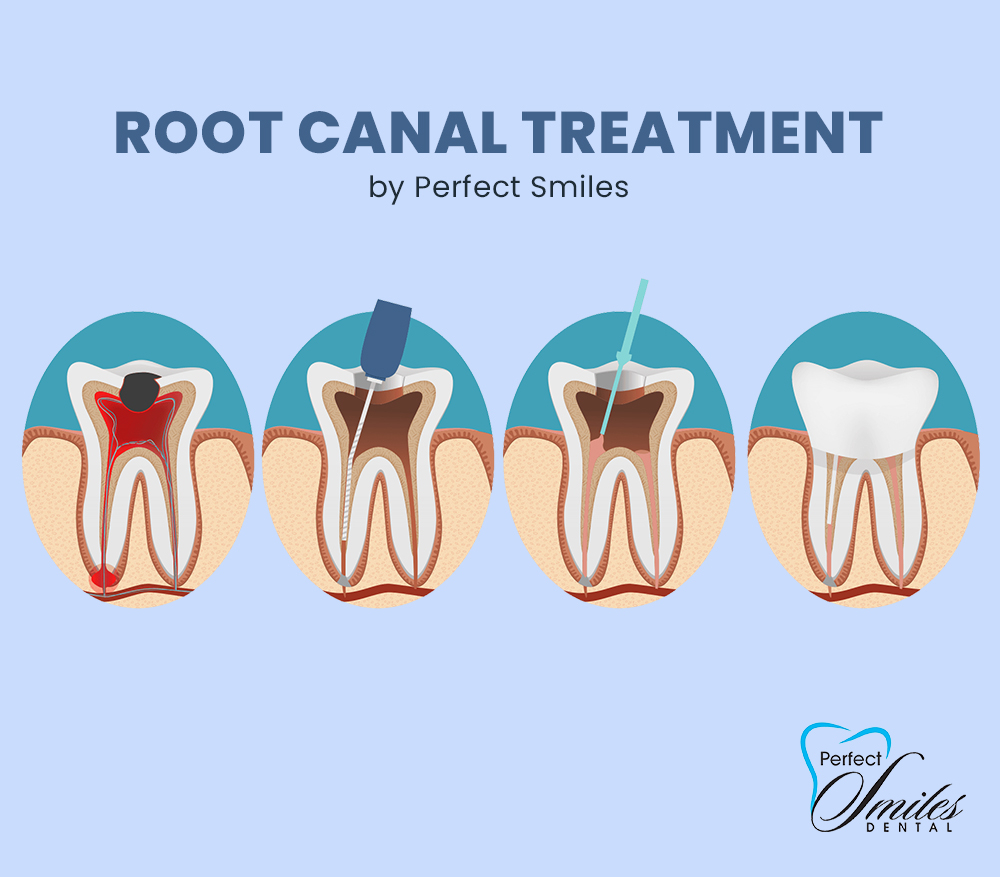 PerfectSmilesVA's tweet photo. We’ll relieve your pain, repair and save your tooth with our gentle root canal treatment.

https://t.co/FUAgBacQTC

#perfectsmile #rootcanal #dental #dentist https://t.co/oaINMVdgwn
