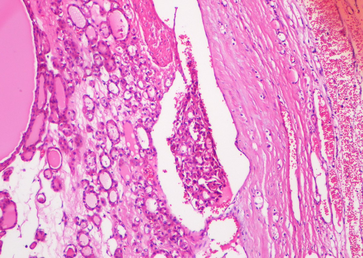 Glzbek1's tweet photo. Follicular Neoplasia in thyroid gland. I've sampled the entire nodule, no capsular invasion. It's just this area, what do you think, vascular invasion or not? #pathology #endocrine #pathlovers #caseoftheday #Endopath #ENTpath https://t.co/efXnecW4lM