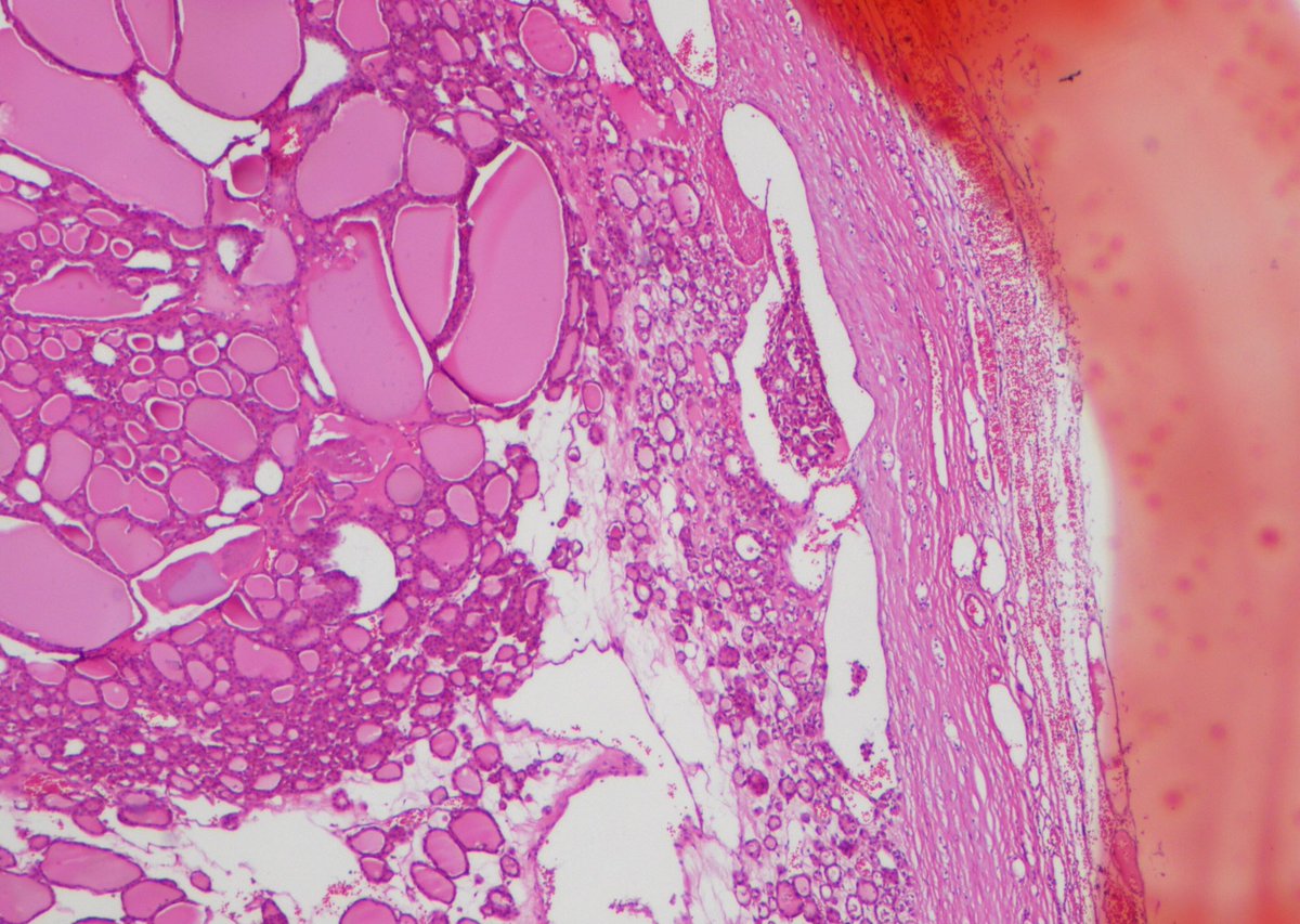 Glzbek1's tweet photo. Follicular Neoplasia in thyroid gland. I've sampled the entire nodule, no capsular invasion. It's just this area, what do you think, vascular invasion or not? #pathology #endocrine #pathlovers #caseoftheday #Endopath #ENTpath https://t.co/efXnecW4lM