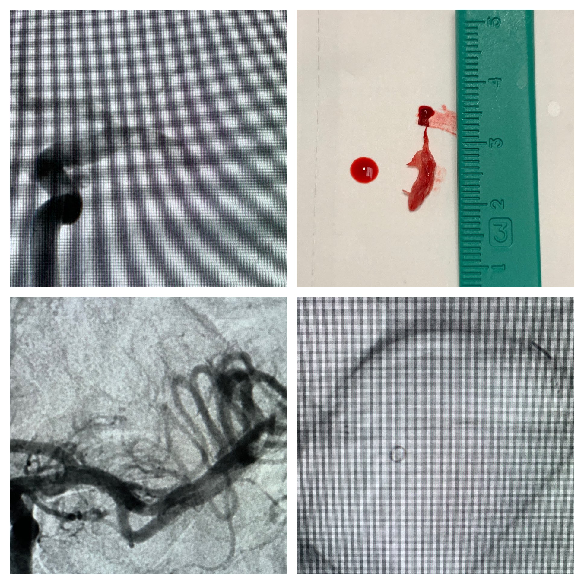 Justin Singer MD, FAANS on Twitter "Left M1 occlusion 2/2 to valvular