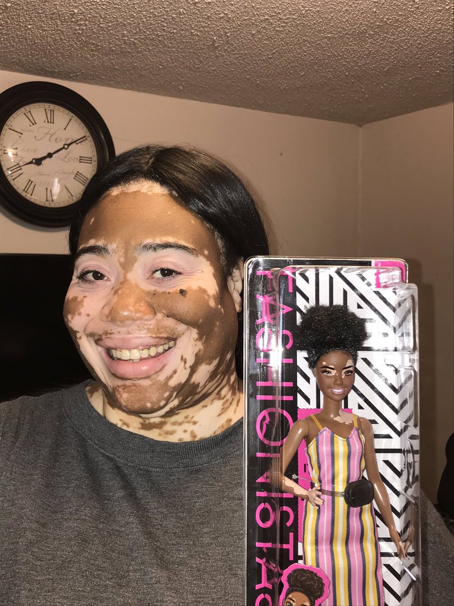 dlightfulwinnie's tweet photo. Super happy about my Barbie! @Mattel thank you for designing the Vitiligo Barbie! https://t.co/HQ7kNVy8wh