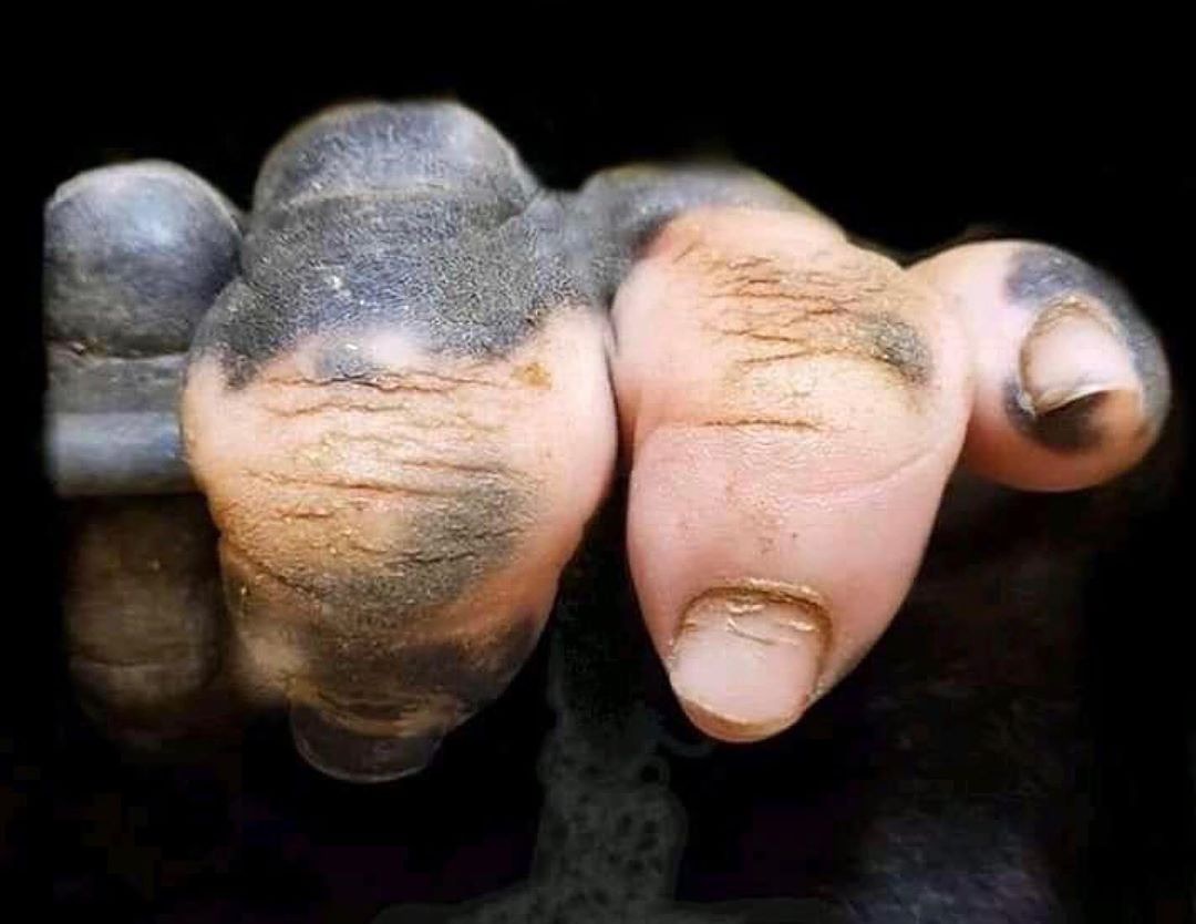 6 yaşında bir goril olan Anaka'nın vitiligo nedeniyle rengini yitirmiş olan parmakları... 😍

📸: Atlanta Zoo