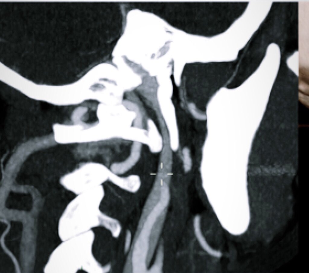 La terribile e mai descritta compressione della giugulare interna fra il processo stiloideo ed il processo trasverso della prima vertebra cervicale bmcneurol.biomedcentral.com/articles/10.11…