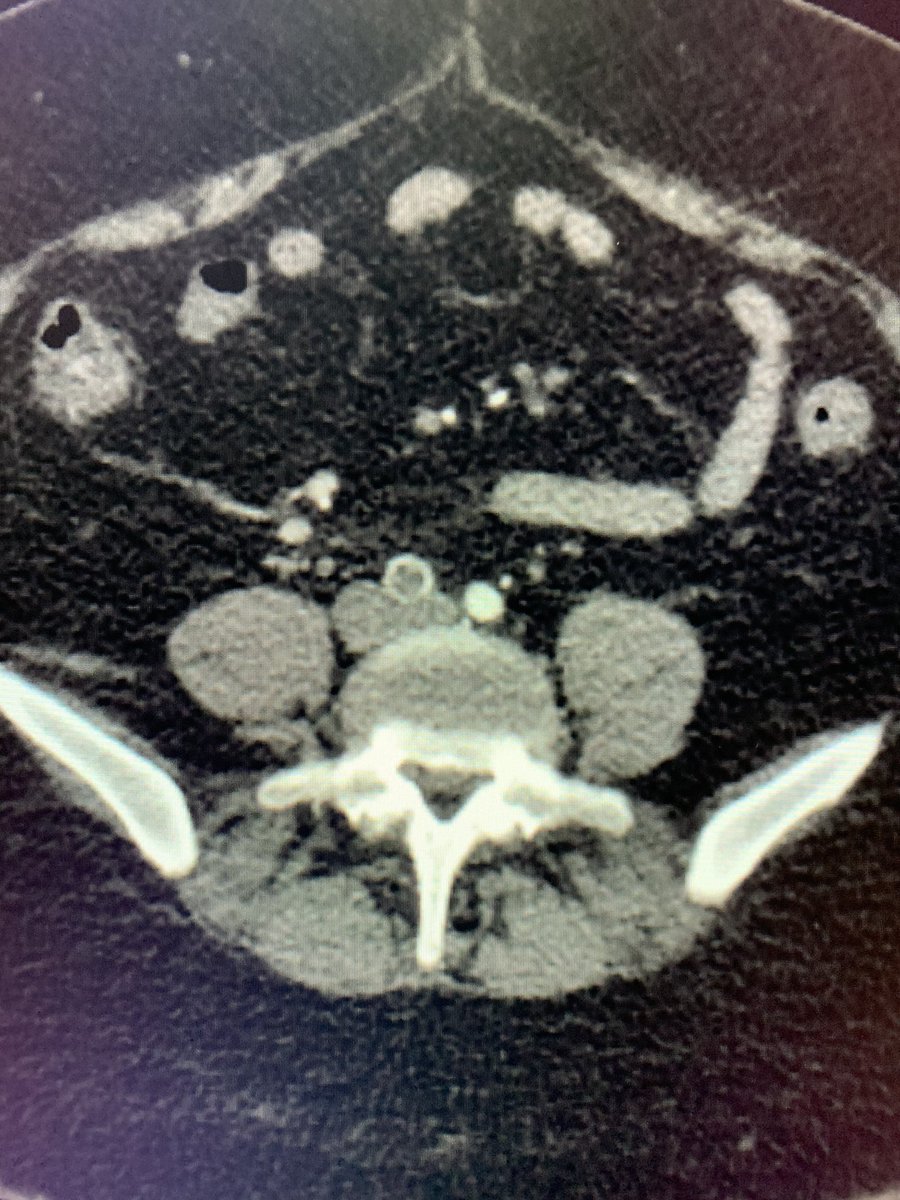t_intheleadcoat's tweet photo. #Legpain and abdominal pain ...Aortoiliac thrombus and appendicitis. #restpain . What would you attend to first #irad @SIRspecialists @SIRRFS @SIR_ECS @JVIRmedia @CVIR_Journal @CAIRads @AMPSymposium #limbischemia #ALI #PAD #Embolus #Thrombus #fogarty #stent #clot @AVIRnews https://t.co/9G1pVMQErH