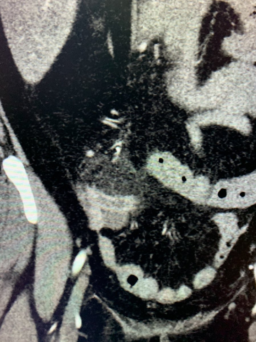 t_intheleadcoat's tweet photo. #Legpain and abdominal pain ...Aortoiliac thrombus and appendicitis. #restpain . What would you attend to first #irad @SIRspecialists @SIRRFS @SIR_ECS @JVIRmedia @CVIR_Journal @CAIRads @AMPSymposium #limbischemia #ALI #PAD #Embolus #Thrombus #fogarty #stent #clot @AVIRnews https://t.co/9G1pVMQErH