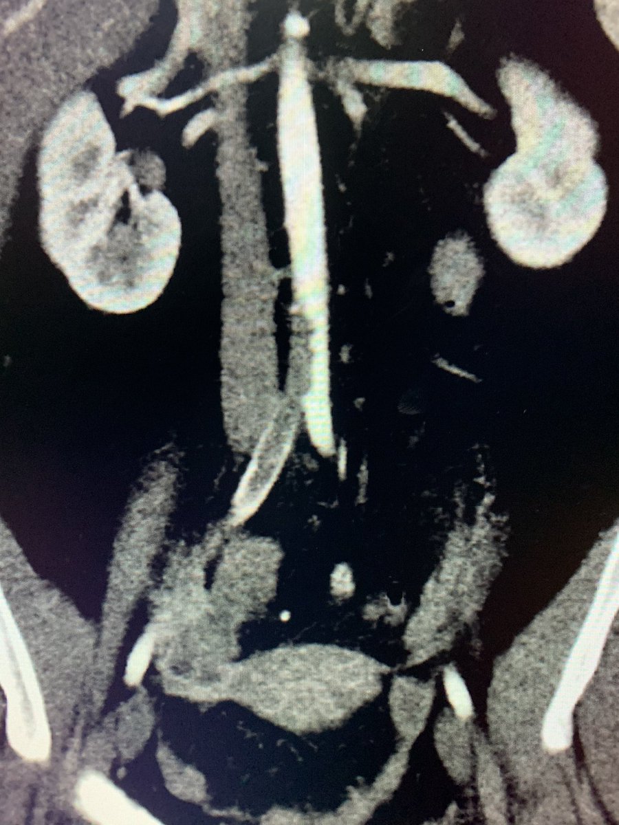 t_intheleadcoat's tweet photo. #Legpain and abdominal pain ...Aortoiliac thrombus and appendicitis. #restpain . What would you attend to first #irad @SIRspecialists @SIRRFS @SIR_ECS @JVIRmedia @CVIR_Journal @CAIRads @AMPSymposium #limbischemia #ALI #PAD #Embolus #Thrombus #fogarty #stent #clot @AVIRnews https://t.co/9G1pVMQErH