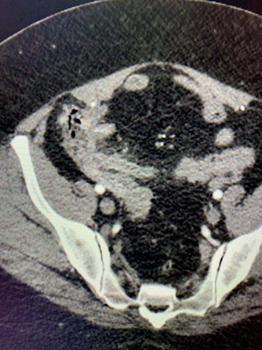 t_intheleadcoat's tweet photo. #Legpain and abdominal pain ...Aortoiliac thrombus and appendicitis. #restpain . What would you attend to first #irad @SIRspecialists @SIRRFS @SIR_ECS @JVIRmedia @CVIR_Journal @CAIRads @AMPSymposium #limbischemia #ALI #PAD #Embolus #Thrombus #fogarty #stent #clot @AVIRnews https://t.co/9G1pVMQErH