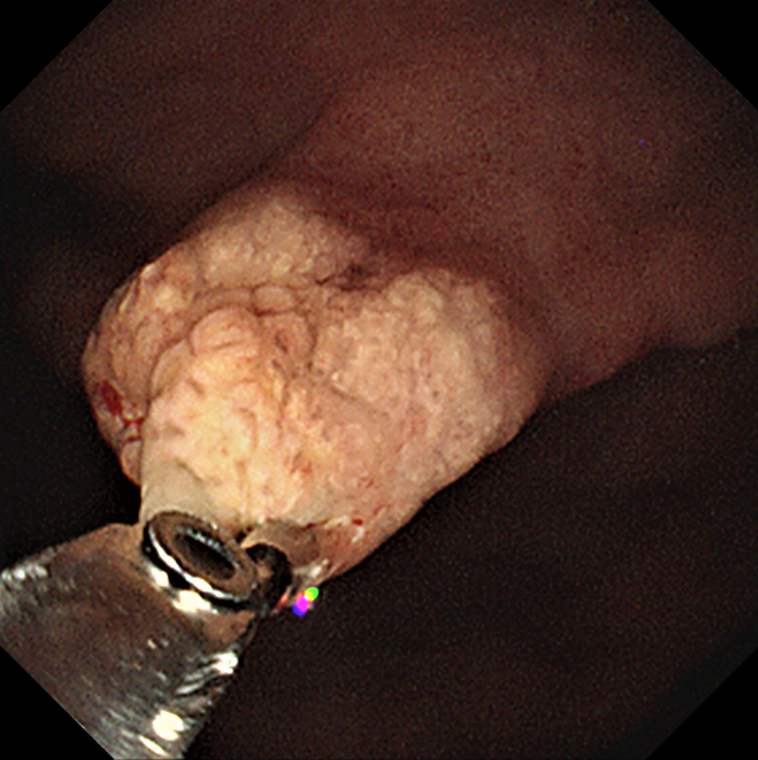 Patholwalker's tweet photo. Xanthoma. Stomach, biopsy. #Pathologist #Pathology #GIpath https://t.co/XCHFUptWrX