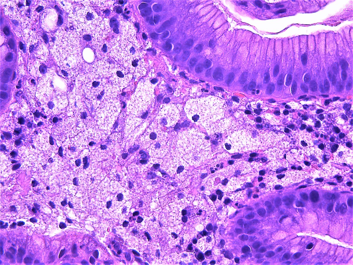 Patholwalker's tweet photo. Xanthoma. Stomach, biopsy. #Pathologist #Pathology #GIpath https://t.co/XCHFUptWrX