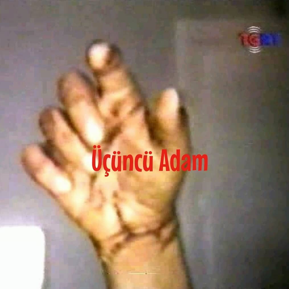 .::Cüneyt Arkın’ın Kopan Elinin Ameliyat Sonrası Çekilen Fotoğrafı::. ucuncuadam.wordpress.com/2019/12/25/cun…
