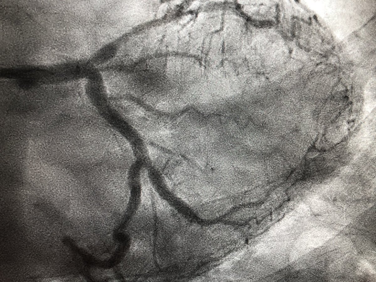 agtruesdell's tweet image. 4/4 Patient-centered decision-making after referral to me: #CompleteRevasc RCA AWE CTO PCI first (4.0mm DES/4.5mm NC), followed later by staged LCX (3.5mm DES) and LAD (4.0mm DES/4.5mm NC) PCI. Both procedures #RadialFirst, #ImageFirst IVUS-guided, and #SameDayDischarge...