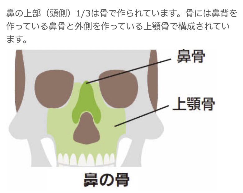 鼻の骨は鼻背を作っている鼻骨と外側を作っている上顎骨で構成されている。上顎手術の際は上顎と鼻中隔軟骨の下側が切り取られる。術後鼻中隔がグラグラになる、鼻は広がりやすくなる。3枚目と4枚目は術前→術後の鼻中隔の変形→鼻中隔修正術後。上顎手術するなら鼻とセットで考えるのがマスト https://t.co/wqLH8tJb1u