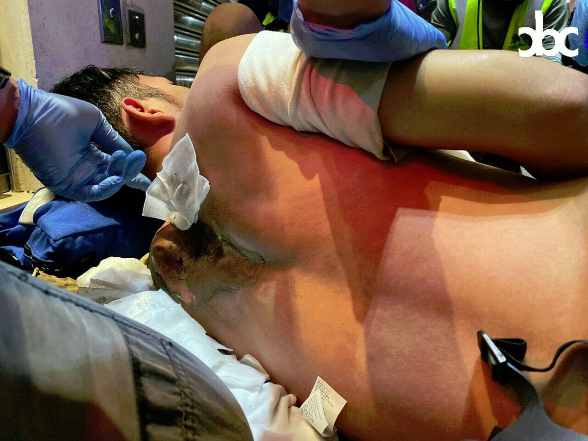 alphacentauriii's tweet photo. This 1st year Uni student was a volunteer first aid during the protest. He got hit by a Chinese Tear Gas canister in his back at Causeway Bay, 11/2. There were sparks at his back after he was shot. The wound was serious and the scar is horrible. #HongKong #HongKongPoliceBrutality https://t.co/UmILmTF4w8