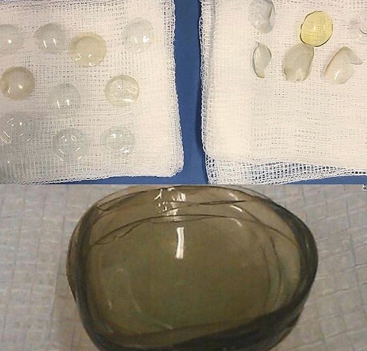 şikayet: Bulanık görme 
kadın hasta 
gözünden 17 şeffaf lens çıkarıldı 
eski lensi çıkarmamış üstüne yenisini takmış
:) 
unutkanlık zor iş :)