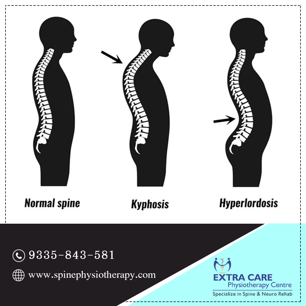 center_extra's tweet image. Kyphosis is a spinal disorder in which an excessive outward curve of the spine results in an abnormal rounding of the upper back. 
#Kyphosis #Spinaldisorder #ExtraCarePhysitherapyCentre #Physiotherapy #Physiotherapist #Lucknow #BackPain  #SpinePhysiotherapy #NeuroPhysiotherapy