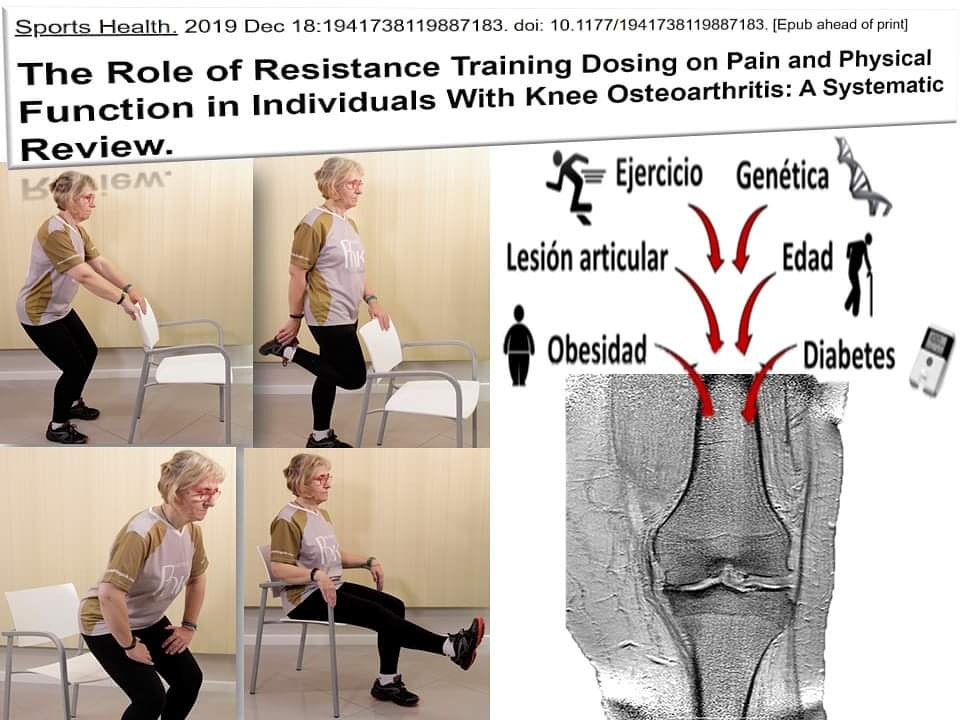felipeisidro13's tweet photo. EJERCICIOS DE FUERZA EN OSTEOARTRITIS DE RODILLA

La osteoartritis (o artrosis) de rodilla es una condición degenerativa articular caracterizada por pérdida progresiva del cartílago articular, hipertrofia ósea marginal (osteofitos) y cambios en la membrana sinovial..
Abro hilo 👇 https://t.co/2XOg2BV8EZ