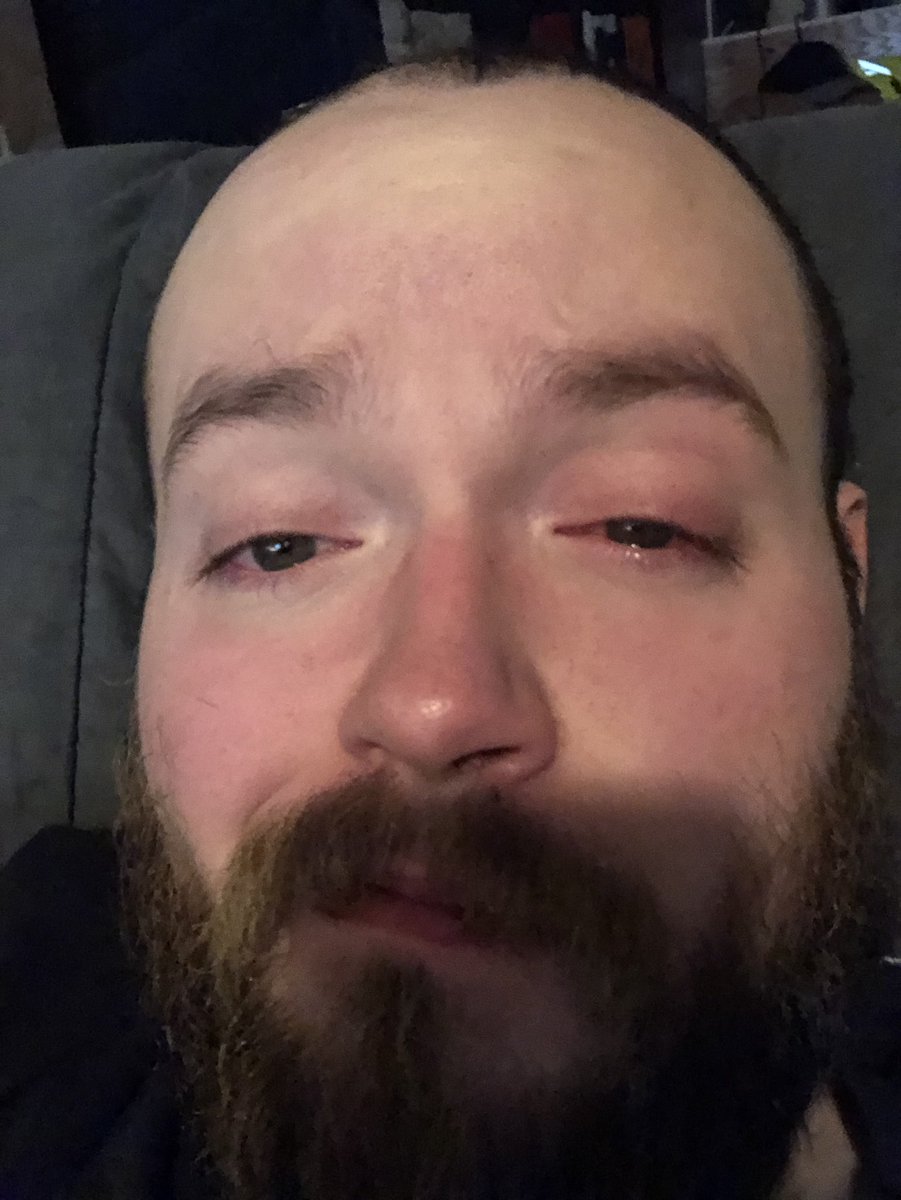 TheInfamousWill's tweet photo. RIP my left eye. https://t.co/9e9WjRw27Y