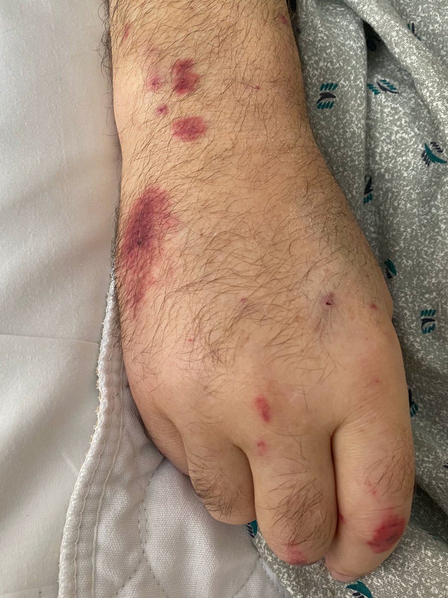 DerekSLarson's tweet photo. 65 y/o w/ advanced T2DM p/w S. Aureus Bacteremia, AKI, and vasculitic rash. Serologies -'ve. Urine sed w/ RBC casts, rash biopsy c/w leukocytoclastic vasculitis. Renal Bx reveals IgA deposition. Diagnosed w/ IgA dominant staph-associated GN (+ tubular injury, nodular diabetic GS) https://t.co/EeV5hbM9ea