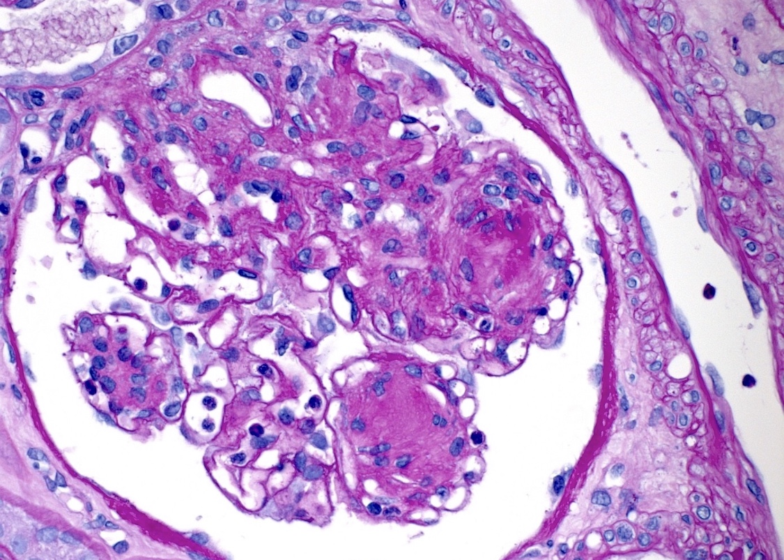 DerekSLarson's tweet photo. 65 y/o w/ advanced T2DM p/w S. Aureus Bacteremia, AKI, and vasculitic rash. Serologies -'ve. Urine sed w/ RBC casts, rash biopsy c/w leukocytoclastic vasculitis. Renal Bx reveals IgA deposition. Diagnosed w/ IgA dominant staph-associated GN (+ tubular injury, nodular diabetic GS) https://t.co/EeV5hbM9ea