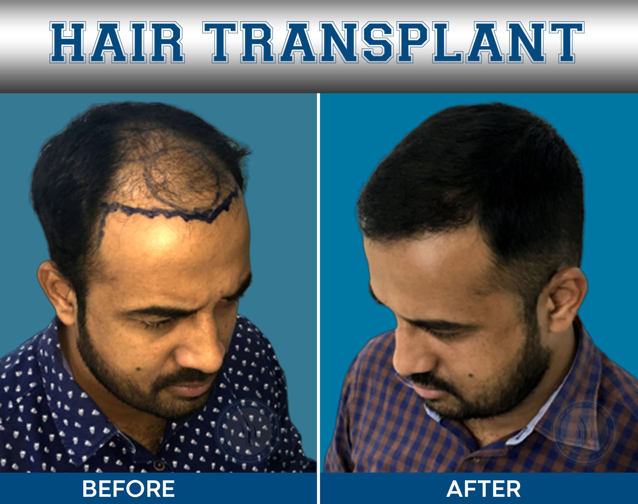 Hairfree And Hairgrow Clinic On Twitter Get The Best Hair Transplant At Hairfree Hairgrow Clinic Pune Surat Vapi Ahmedabad Mumbai Delhi Know About Hair Transplant Technology Cost Benefits Side Effects Visit Https T Co Dlvaa433ot For More