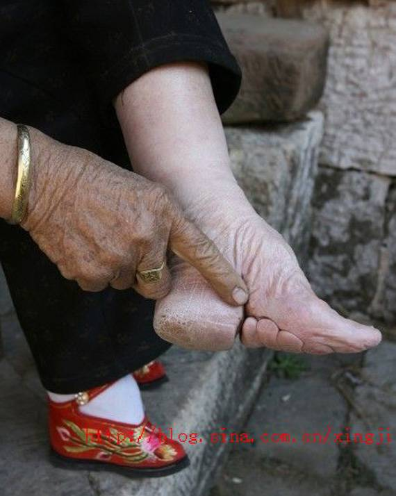 Yumi ゆみ 纏足 てんそく 幼児期より足に布を巻かせ 足 が大きくならないようにするという かつて中国で女性に対して行われていた風習をいう より具体的には 足の親指以外の指を足 の裏側へ折り曲げ 布で強く縛ることで足の整形 変形 を行うこと
