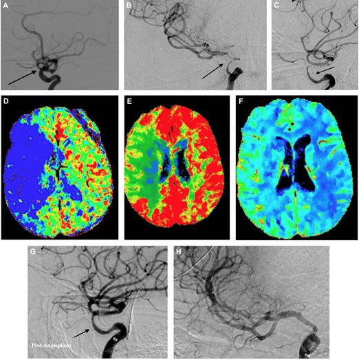 NeurosurgeryCNS's tweet photo. #NEUAdvanceAccess Sweid et al. assess the predictors of complications, morbidity, and unfavorable outcomes in a large cohort of patients with aneurysms treated with the Pipeline Embolization Device https://t.co/466HbyRvP0 https://t.co/9jw2Iu19k8