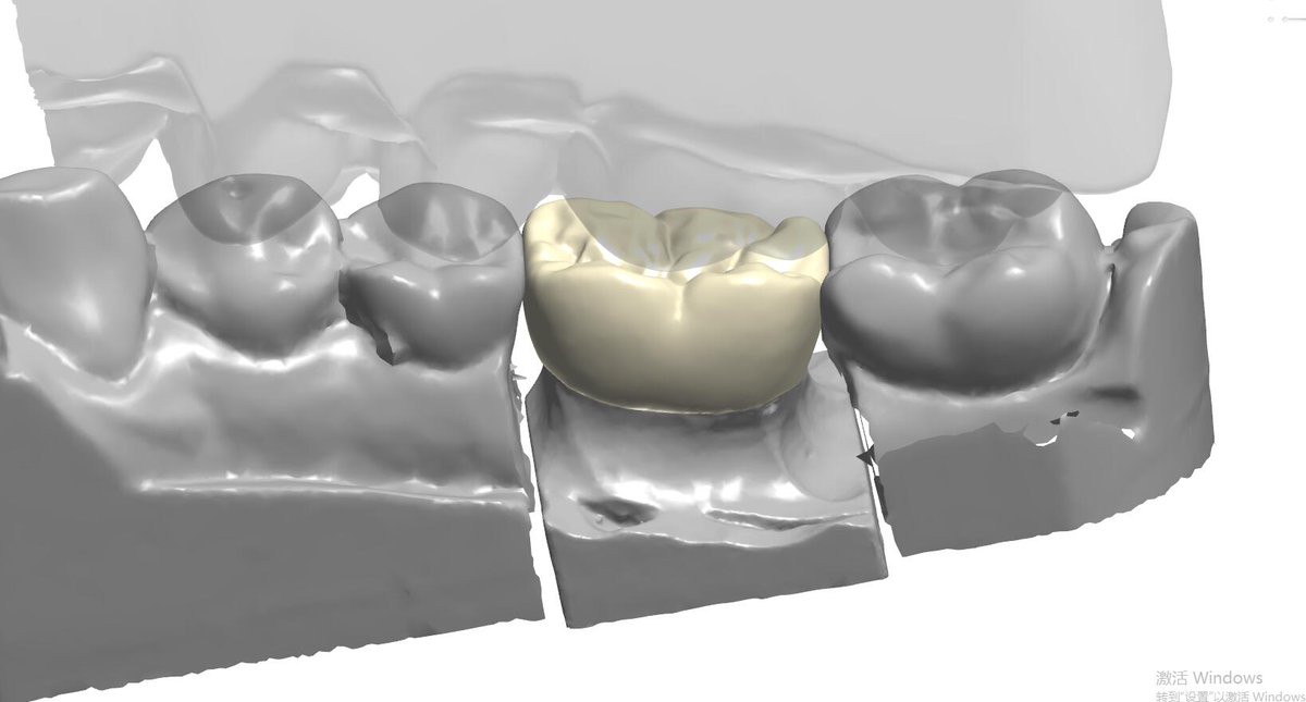 Ian Dental Design Studio, if you need to outsource design dental crowns, veneers, models, implants.
contact me .WeChat：+8618318409059/email：18318409059@163.com/WhatsAPP:+8618318409059