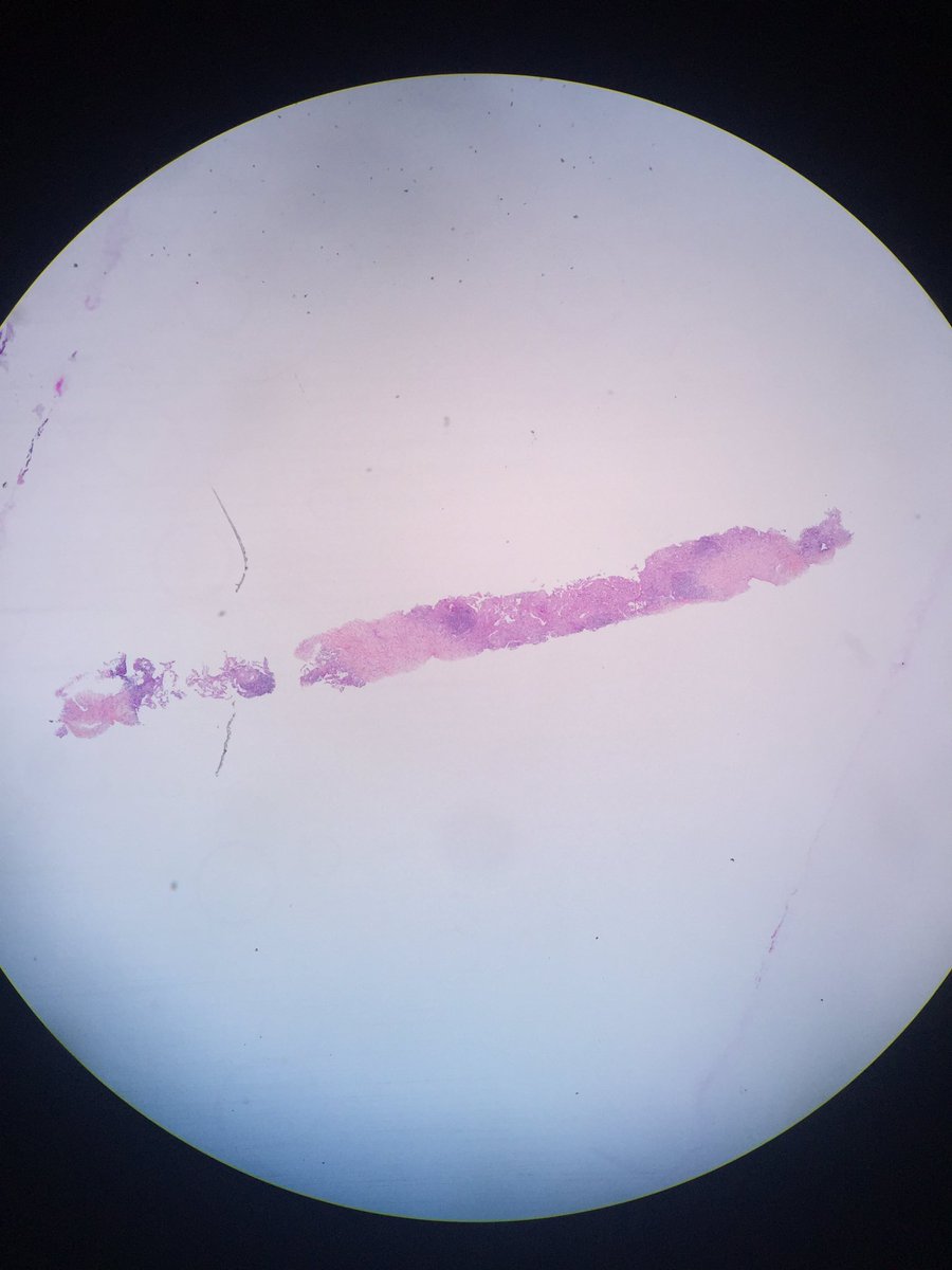 pipoulou_kgb's tweet photo. ⁉️🔬#pulmpath #lungpathology 68YOM with a 5cm apical left side hypermetabolic excavated nodule. How do you name these structure↘️? 🔬⁉️@smlungpathguy @yro854 @PulmPathSoc @ArchivesPath @goll_burdach @lara_pijuan @TexPathol @ARP_Press @ariella8 @DrRolaAli @Era6strate @SGottesmanMD https://t.co/vhMxf4r0Cy