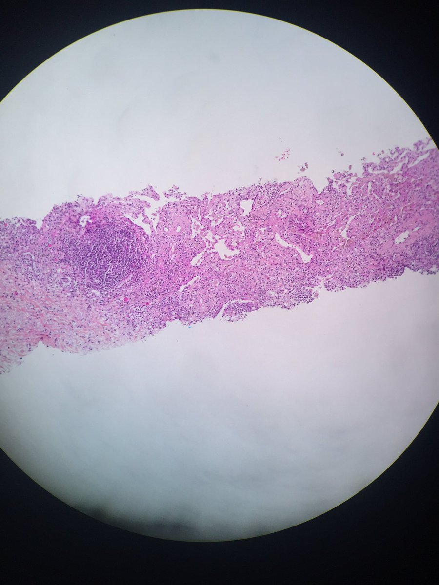 pipoulou_kgb's tweet photo. ⁉️🔬#pulmpath #lungpathology 68YOM with a 5cm apical left side hypermetabolic excavated nodule. How do you name these structure↘️? 🔬⁉️@smlungpathguy @yro854 @PulmPathSoc @ArchivesPath @goll_burdach @lara_pijuan @TexPathol @ARP_Press @ariella8 @DrRolaAli @Era6strate @SGottesmanMD https://t.co/vhMxf4r0Cy