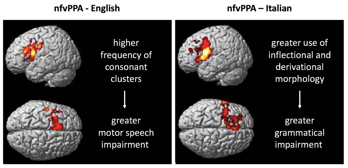 Hot off the press: native language features influence the phenotype & clinical presentation of #PrimaryProgressiveAphasia More cross-cultural & cross-linguistic studies are warranted to improve our diagnostic criteria. Enjoy our latest work @GreenJournal: tiny.cc/nfvPPAEI