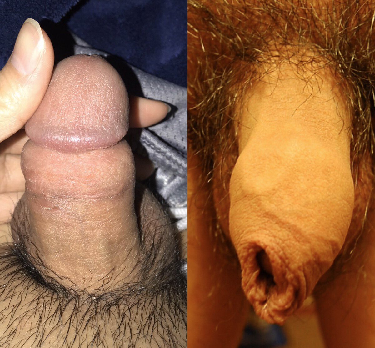 Swollen Foreskin On Uncircumcised Men Penis.