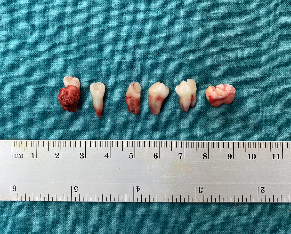 XavierPerez_'s tweet photo. Sera que la muerde? 🤔 Will it bite her? #teratoma #ovary #protuberance #Rokitansky #pathology https://t.co/UmAVIt6caO