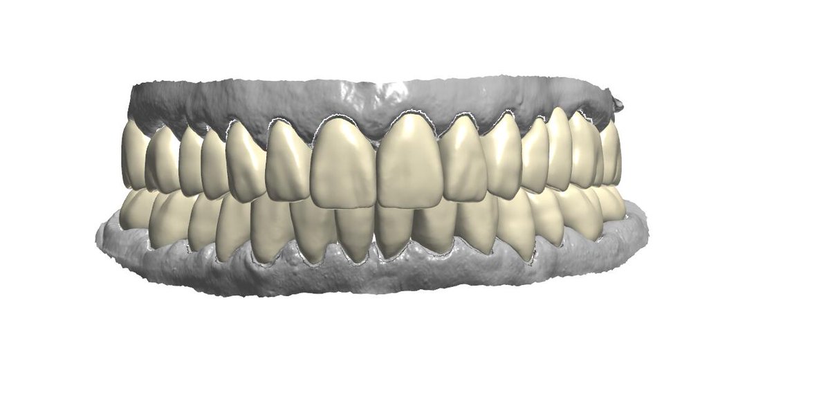 ImpChenCAD's tweet photo. Ian Dental Design Studio, if you need to outsource design dental crowns, veneers, models, implants.
contact me .WeChat：+8618318409059/email：18318409059@163.com/WhatsAPP:+8618318409059 https://t.co/gtJsG1oVAH