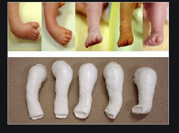 Odah_K_kine's tweet photo. Parce qu'elle a un #Pied_bot, le maman à son possible fiancé refuse de leur union... Une atteinte grave à la vie d'une #personne_en_situation_de_handicap : discrimination et marginalisation : plus jamais ça !
#Handicap
@WCPT1951 @AWcpta @cnomk @Handicap_fr @UnHandicap https://t.co/nyvyqPbfzm
