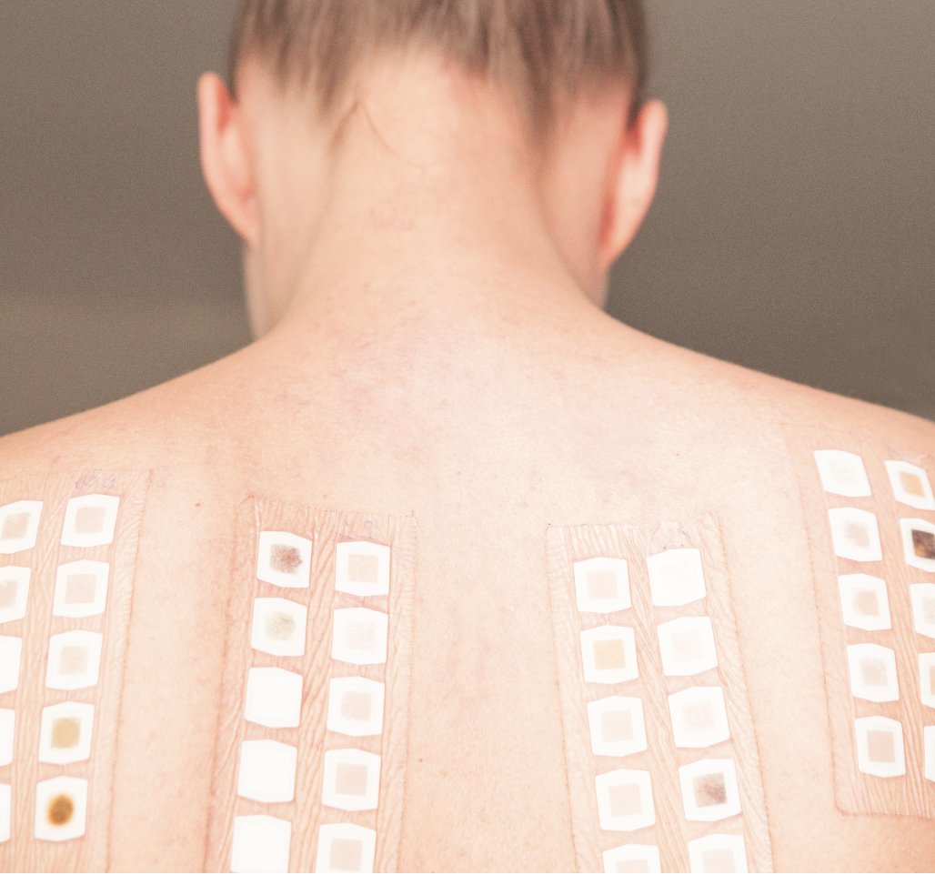 Derm_info's tweet photo. Several circumstances may interfere with the patch test results, like acute dermatitis, intensive UV exposure or long-term pretreatment with topical corticosteroids. https://t.co/58fPlxdf0l
