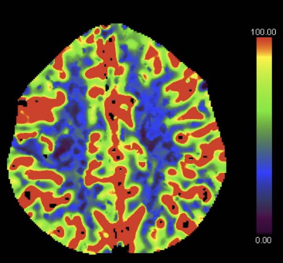 interneurona's tweet photo. #NIHSS 3, con 5 hr presentación.
#Angiotac sin visualización de vaso mayor tapado. #CTP muestra defecto M3
👉EXTEND IV https://t.co/wkhyF9OH3T