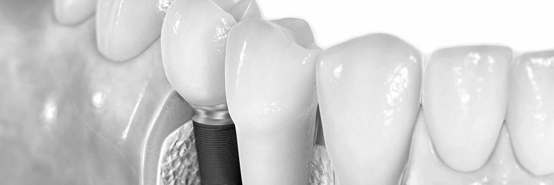 idexdental's tweet photo. Seguro que, si te falta un diente, más de una vez te has hecho la pregunta: ¿debo colocarme un implante dental? 
En este artículo te dejamos información https://t.co/WKuZJ81shf
Si tienes dudas, llama gratis al 900 26 44 22 o tu cita online en tu clínica Idex Dental. https://t.co/DU7mEI6cy3