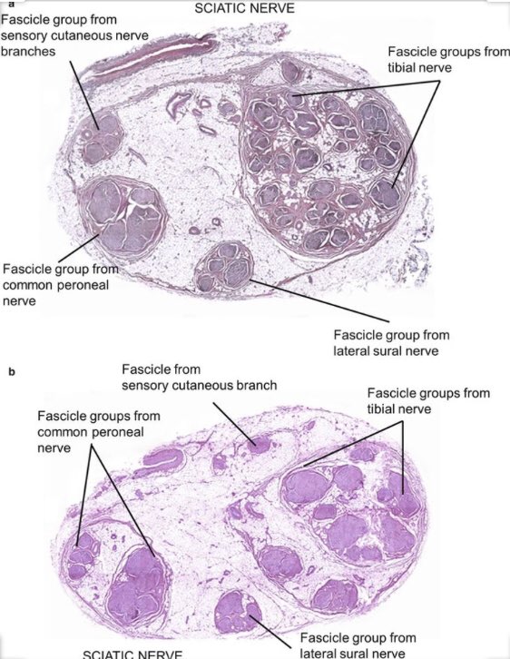 Curiosidades del sistema nervioso humano. ¿Sabias que el nervio tibial (L4-S3) es el nervio más largo del cuerpo humano? Pues así es. Además es interesante saber que el nervio ciático mayor está ya dividido en su salida por el agujero ciático mayor compartiendo el mismo epineuro.