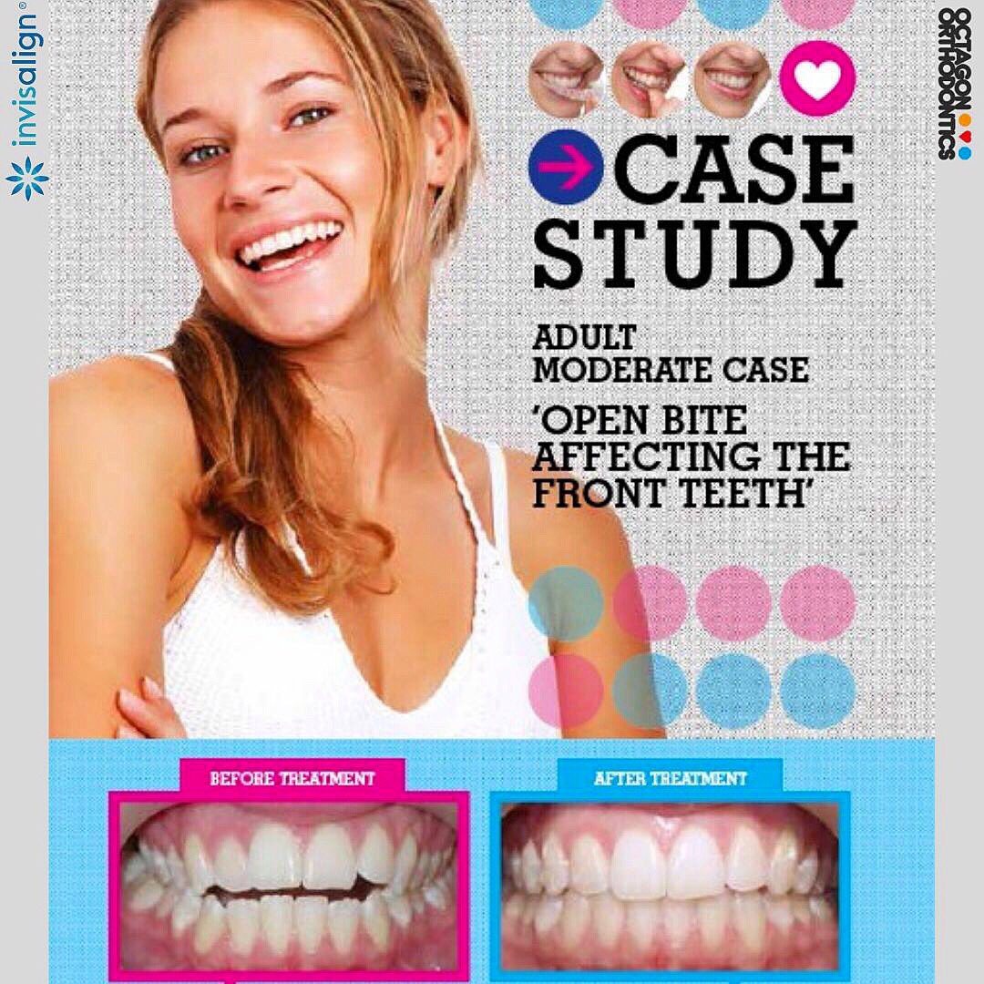 OctagonOrtho's tweet photo. Naomi said: “My open bite is affecting my front teeth”. Invisalign treatment corrected the patients open bite + straighten upper &amp; lower teeth. 

More information on Invisalign treatments: https://t.co/ujGurEDnnV

Contact Us: 01494513797
 https://t.co/OfNGHCE3Gb https://t.co/YXQ4ov0Q7t