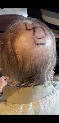 StandWithUs's tweet photo. Disgusting: Family outraged by swastika drawn on uncle's head at Toronto care facility. https://t.co/4KndH159Ml