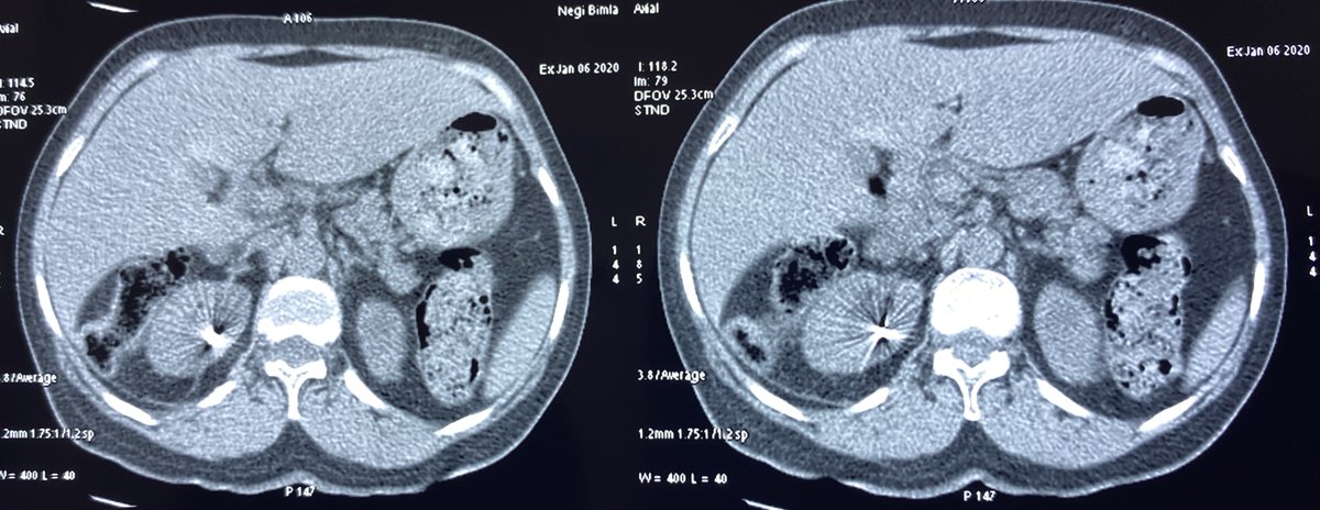 SudheerDevana's tweet photo. Always think of severe #bleeding and #angioembolization in the past, if you find a bright star in the #kidney in a known case of #renalstone disease😀#PNL #urolithiasis #UrosomeIndia #endourology https://t.co/jtizIgcsZU
