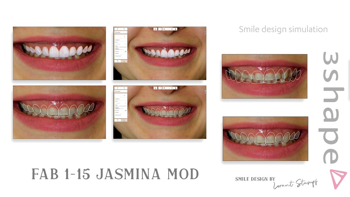 LorantStumpf's tweet photo. I usexthe #3shape smile design software newest version. I used the 2D template of #fabouloussmile with modifications.#digital, #dentistry, #cad, #cam, #digitaldentistry, #cerec, #3shape, #3shapetrios, #implants, #digitalsolution, #digitalrestoration, #dentallab, #printing https://t.co/Q0D3i0QZl3