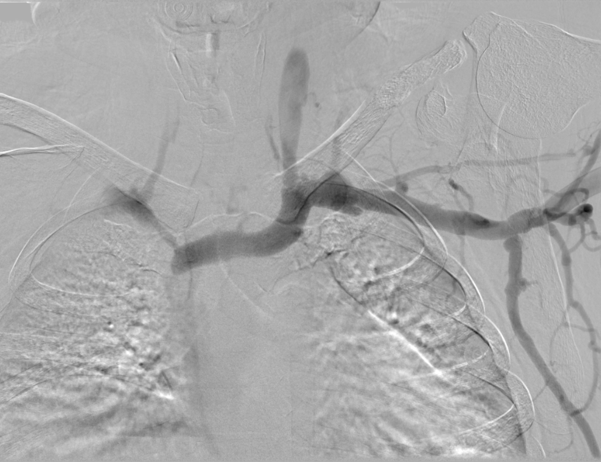 NshRadiology's tweet photo. 50 Y O Male with left AVF and difficulty dialysis. #Central #Venoplasty by #IRad #Intervetion #Radiology #Makkah https://t.co/cJEZULsvMt