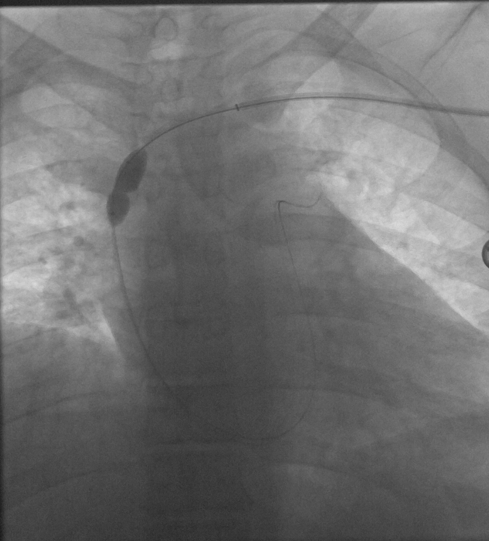 NshRadiology's tweet photo. 50 Y O Male with left AVF and difficulty dialysis. #Central #Venoplasty by #IRad #Intervetion #Radiology #Makkah https://t.co/cJEZULsvMt