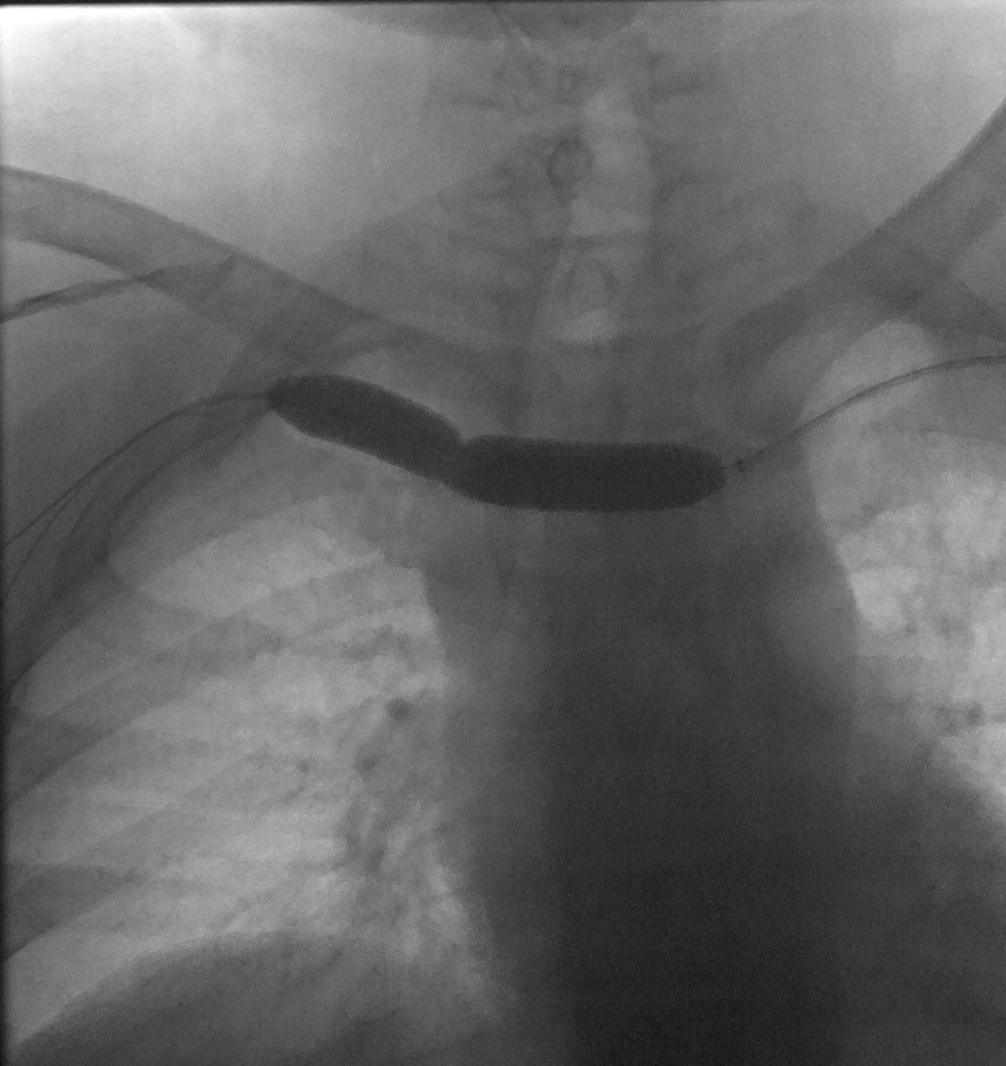 NshRadiology's tweet photo. 50 Y O Male with left AVF and difficulty dialysis. #Central #Venoplasty by #IRad #Intervetion #Radiology #Makkah https://t.co/cJEZULsvMt