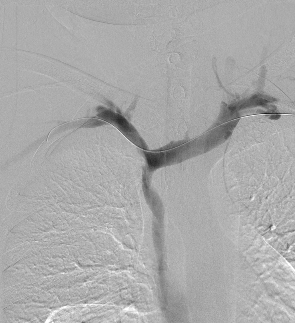 NshRadiology's tweet photo. 50 Y O Male with left AVF and difficulty dialysis. #Central #Venoplasty by #IRad #Intervetion #Radiology #Makkah https://t.co/cJEZULsvMt