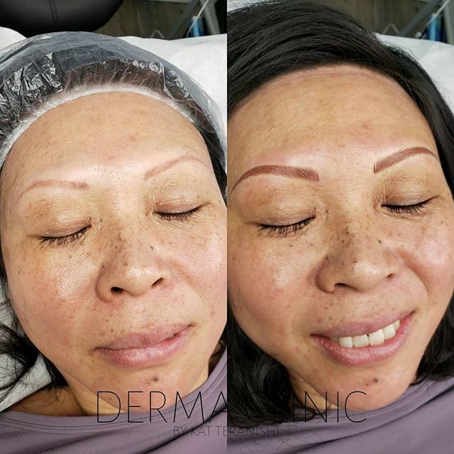 DermaClinicBC's tweet photo. Oftentimes I get asked if the brow color should match the hair on your head. I say "no" as long as it matches your brow hair color you're good. After all, we dye our hair and the colors can change by the season but that doesn't mean that we will change her brow hair colour e… https://t.co/A8apHvY9Bt