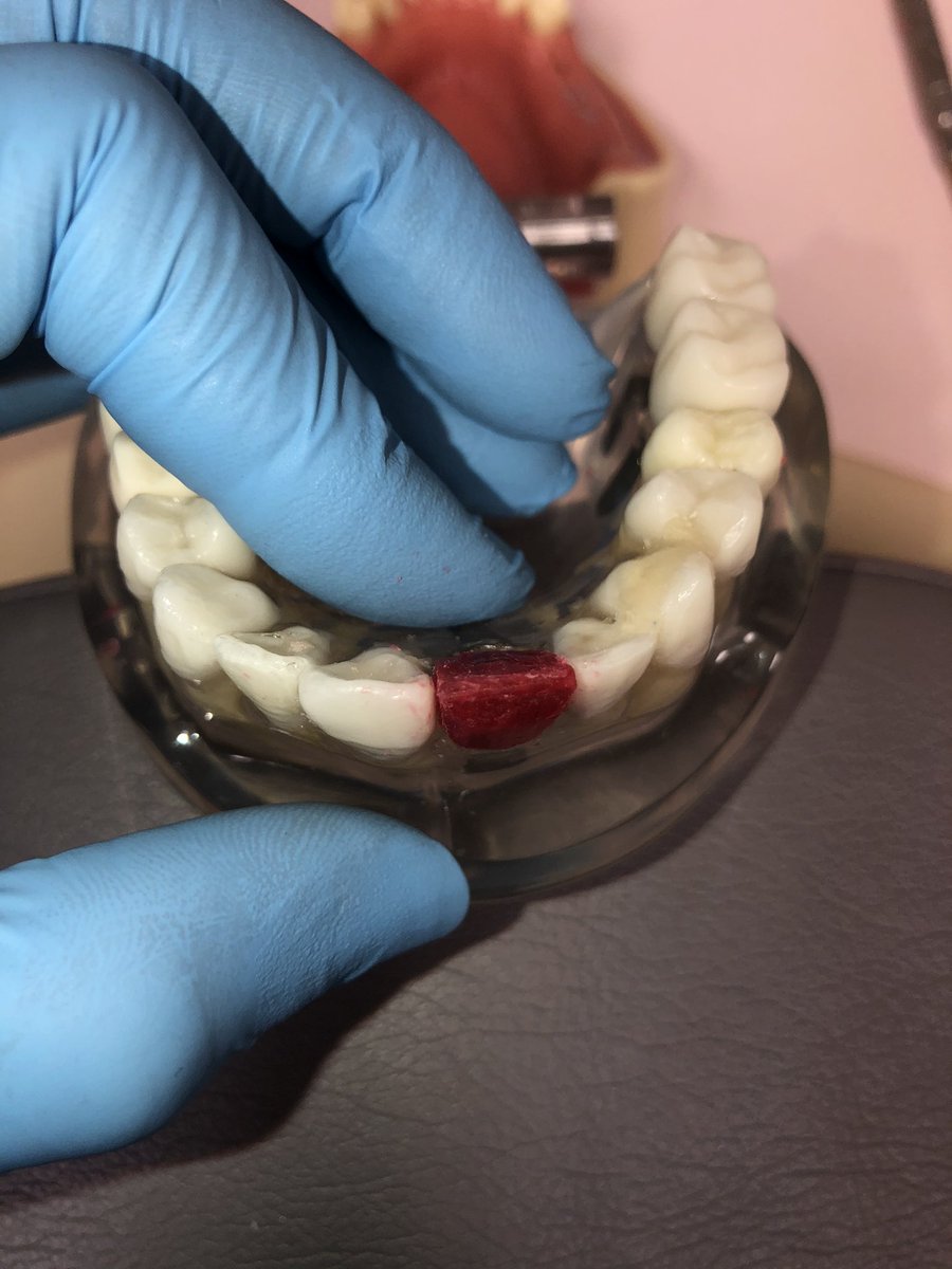misslexiiibaby's tweet photo. Making wax sculptures for provisional crowns (creating a tooth thatโs not there out of rope wax ๐) #InMyFreeTime https://t.co/MqWOiQNLYe