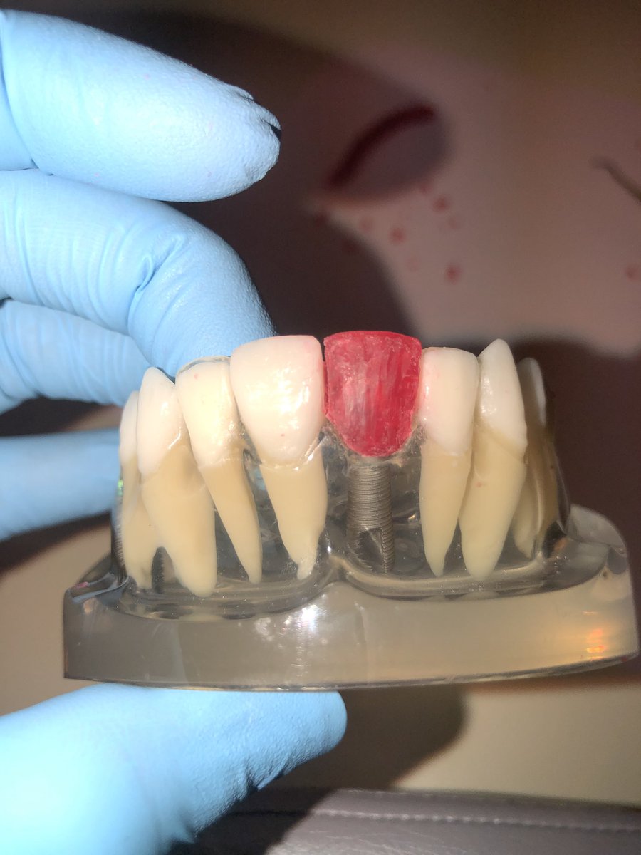 misslexiiibaby's tweet photo. Making wax sculptures for provisional crowns (creating a tooth thatโs not there out of rope wax ๐) #InMyFreeTime https://t.co/MqWOiQNLYe