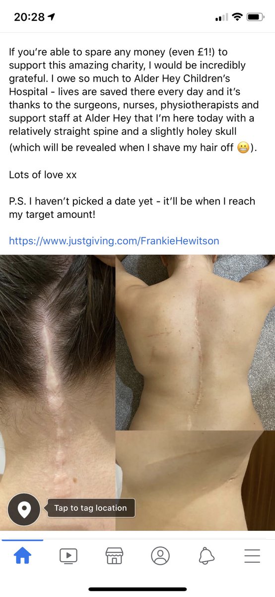 cescahewitson's tweet photo. Shaving my hair off to raise money for @AlderHeyCharity - please read and please donate if you can ☺️ https://t.co/fgO7StvZxM https://t.co/7zUUlj3zmI